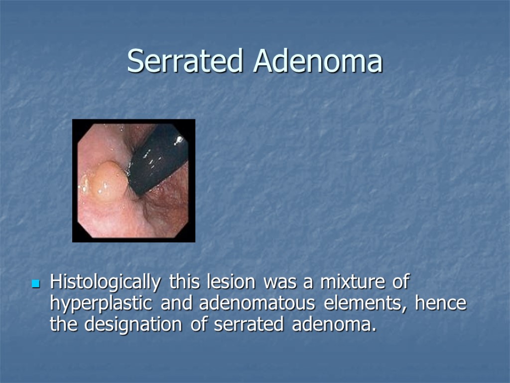 Serrated Adenoma Histologically this lesion was a mixture of hyperplastic and adenomatous elements, hence